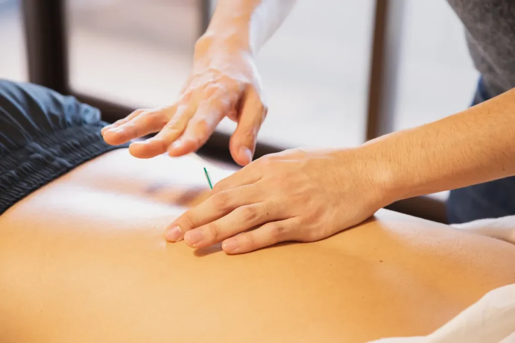 Practitioner placing needles along a patient's back
